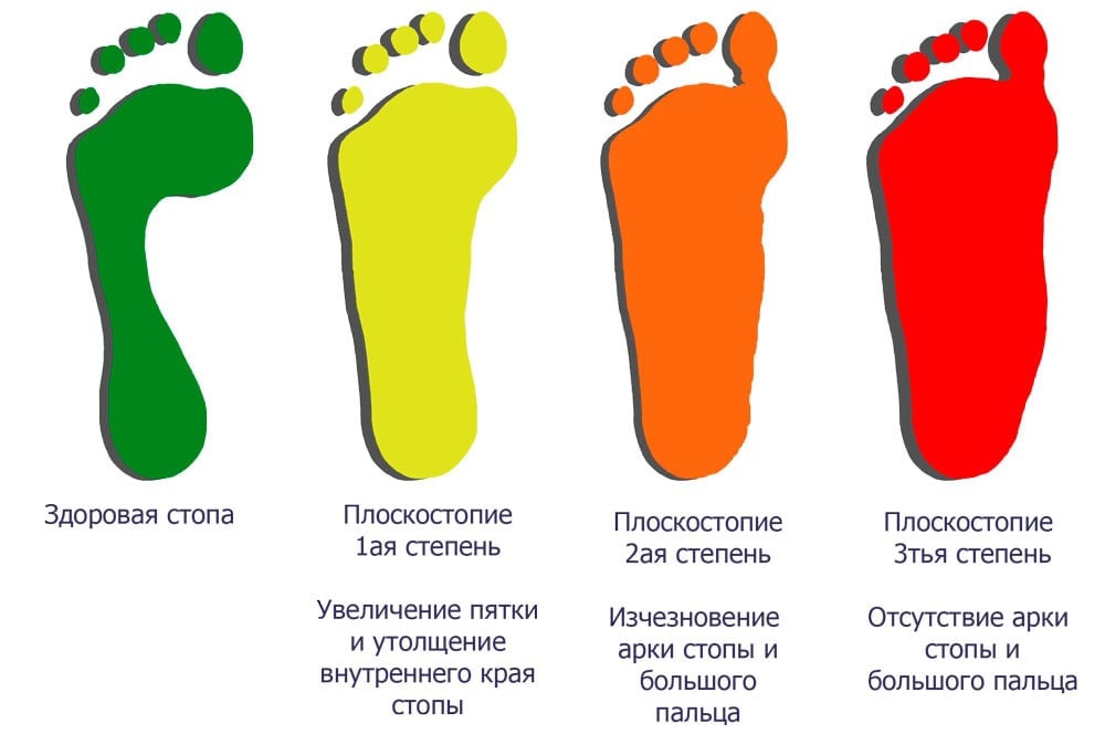 Рассмотрите рисунок с изображением стопы человека как называют нарушение формы стопы
