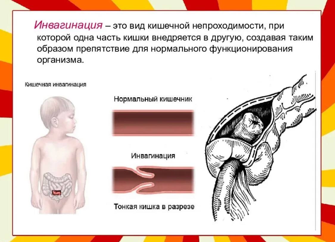 Инвагинация кишечника. Этиология инвагинация кишка. Кишечная непроходимость Триада симптомов. Виды кишечной непроходимости инвагинация. Патогенез инвагинация кишка.