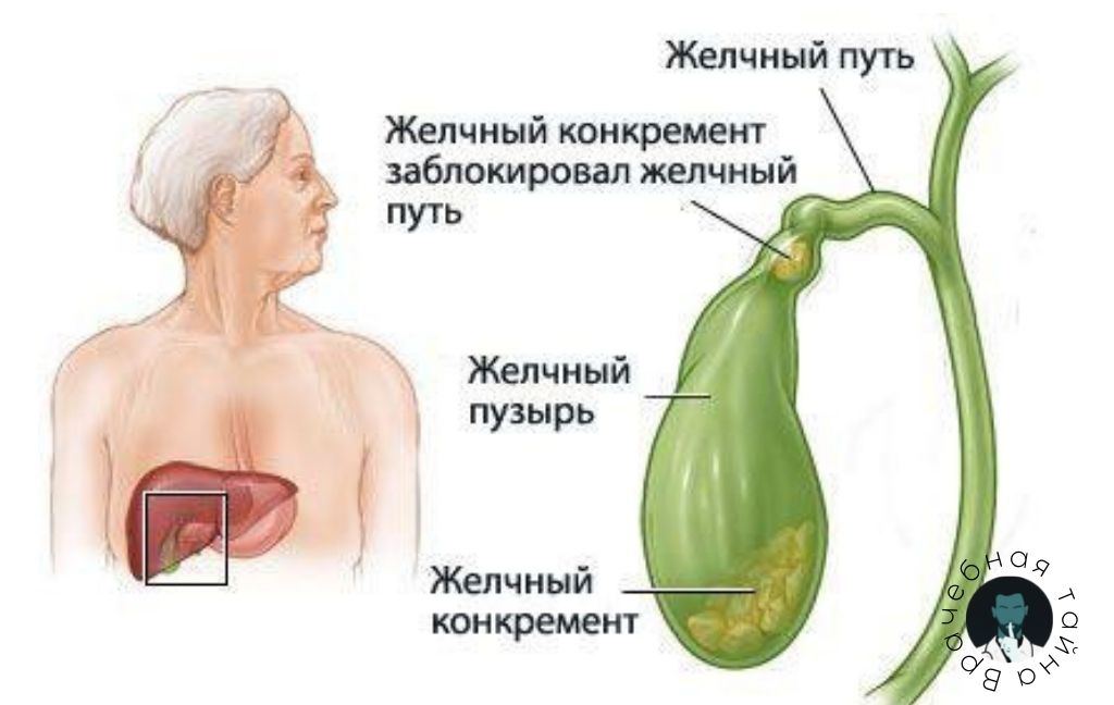 Консервативное лечение полипов желчного пузыря. Консервативное лечение полипов желчного пузыря. Консервативное лечение полипов желчного пузыря. Видео полипом чем лечится. Консервативное лечение полипов желчного пузыря.