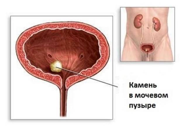 Камни при мочеиспускании как выглядят #1065 post - Доктор Семёнов Мужское Здоровье (@male_doctor)